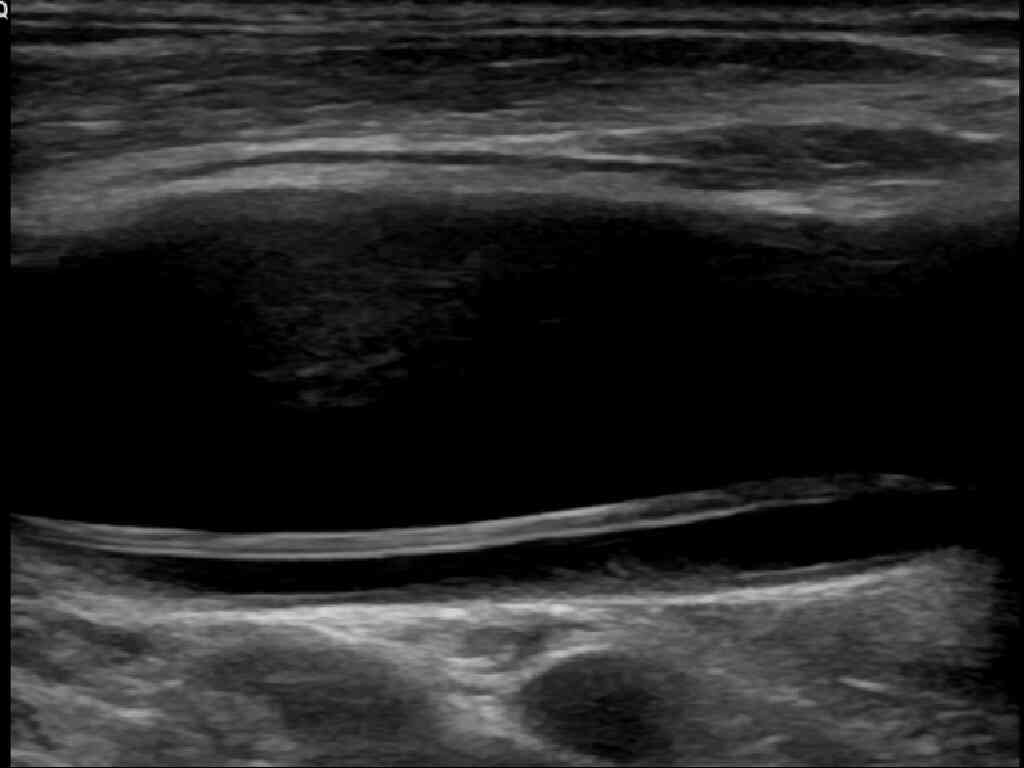 A common carotid artery dissection ultrasound