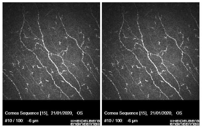 Corneal confocal microscopy image