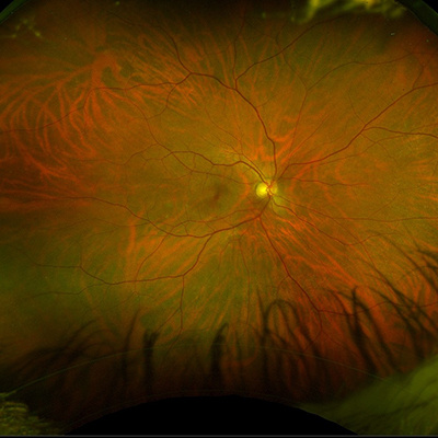 Normal retina of 50 y.o male captured using ultra-wide angle retinal camera (Optos model P200dTx)