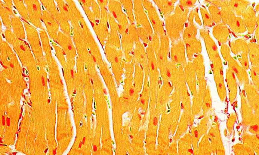 Effects of metformin on cardiac function in Type 1 diabetes.