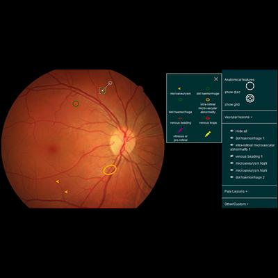 A screenshot of the CREDIS - Fundus lesion annotation tool