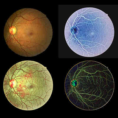 Creative take / artwork of fundus photography by team members Chris Ryan and Hilary Richardson.